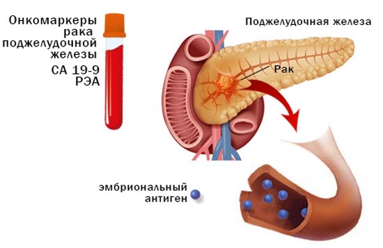Онкомаркеры поджелудочной железы