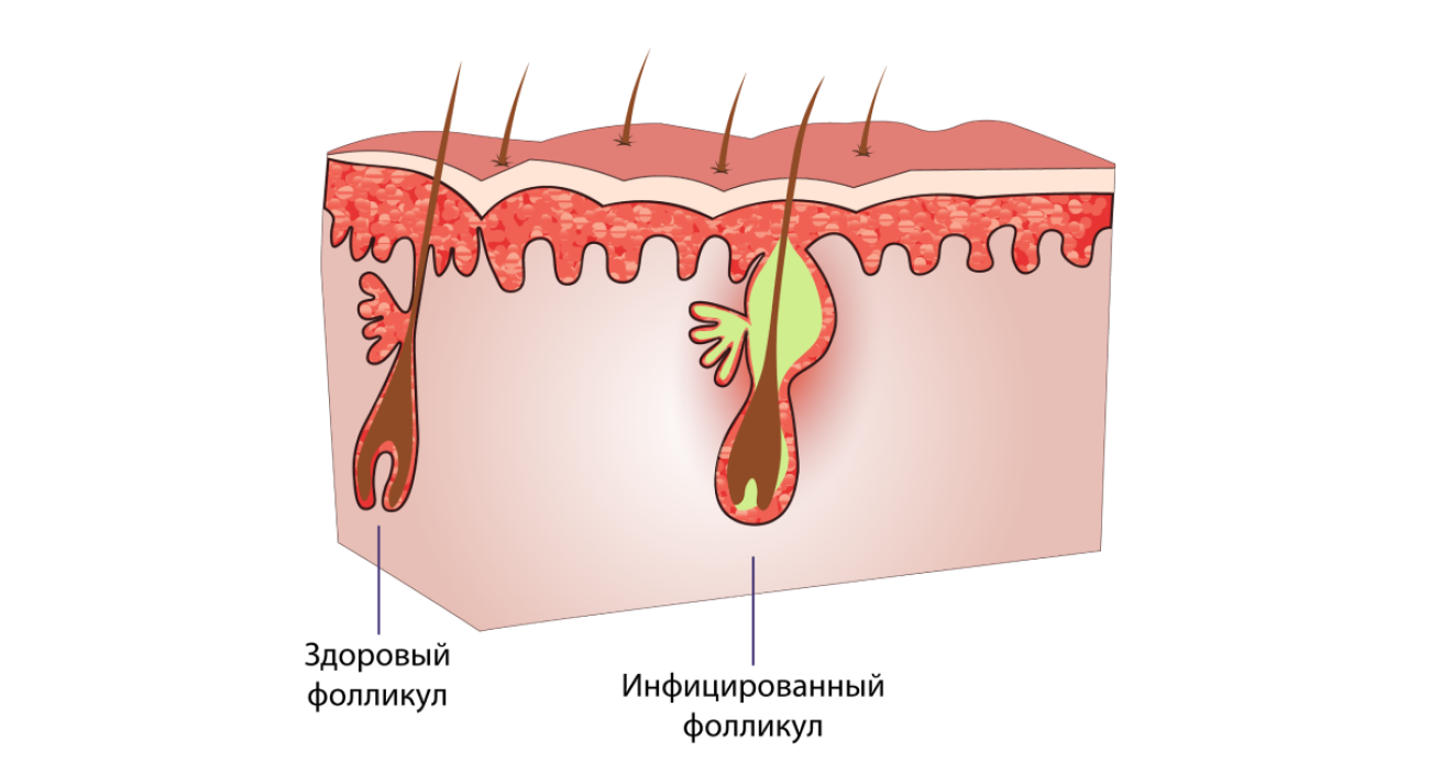 Фолликулит