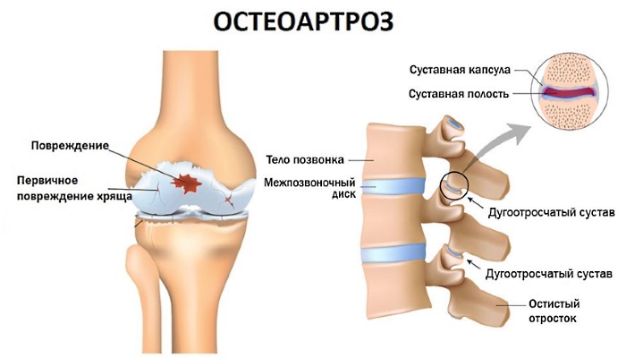 Что такое остеоартроз?