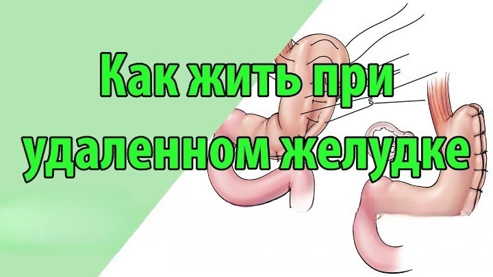 удален желудок - как жить?